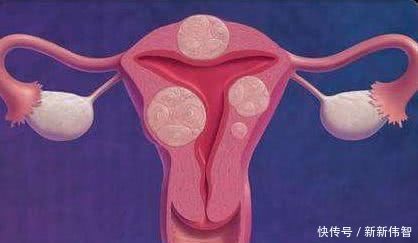 女性如何预防子宫肌瘤?不用担心喝豆浆,真正要远离3种常见美食