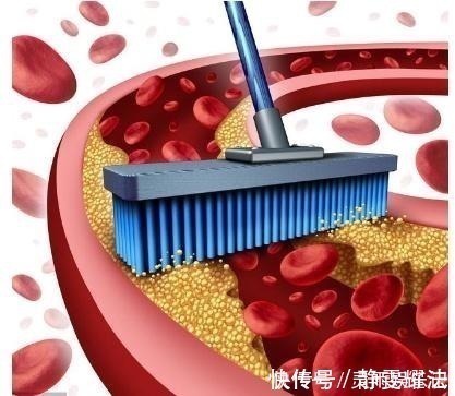 急性胰腺炎|改善高血脂其实可以不用吃药,医生提出2条实用建议,比药强多了