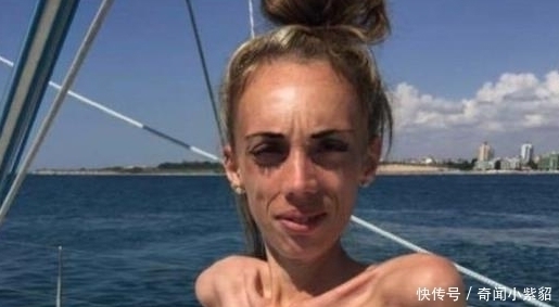 女子|女子患病瘦到25公斤,走在街上,人人躲她,增肥后惊艳大家