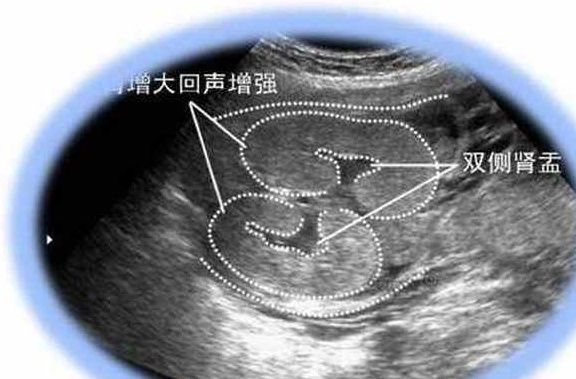 胎儿|怀孕6个月，胎儿双侧“肾盂”未见分离，究竟是男孩还是女孩？