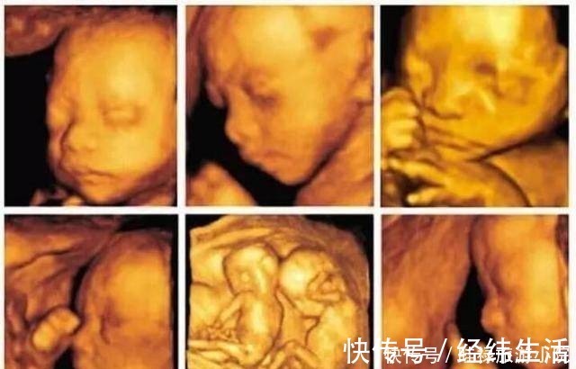 产检|孕期产检不想生个“傻孩子”,这三项产检必须按时做,不能忽视