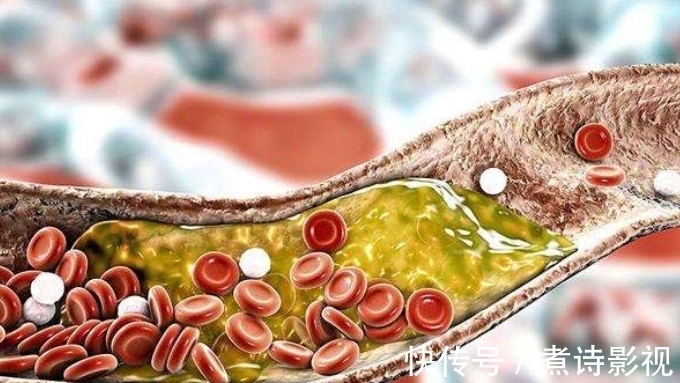 猪脑花|胆固醇“榜单”已公布,蛋黄排第三,2物吃一口血脂涨50倍,别贪吃