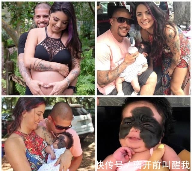 面具|7个月婴儿脸上因巨大黑色胎记爆红!像带着“蝙蝠侠”面具!