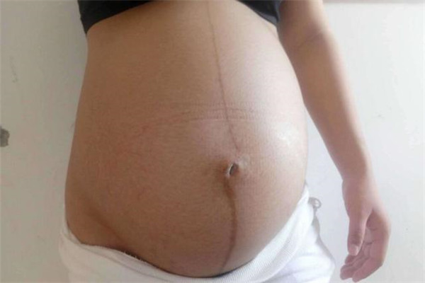 准妈妈|怀孕时肚子上的“黑线”代表啥还有孕妈不知道,看完就明白了