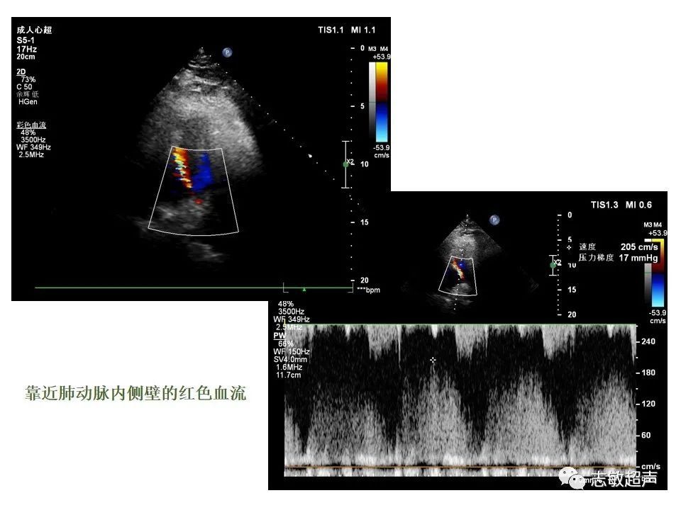 超声|肺动脉瓣周边异常血流的超声鉴别
