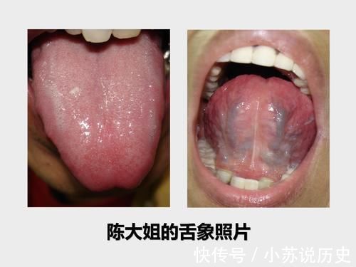 左手脉|50多岁大姐近来老是头晕,一量血压高压180,原来舌象早已预警