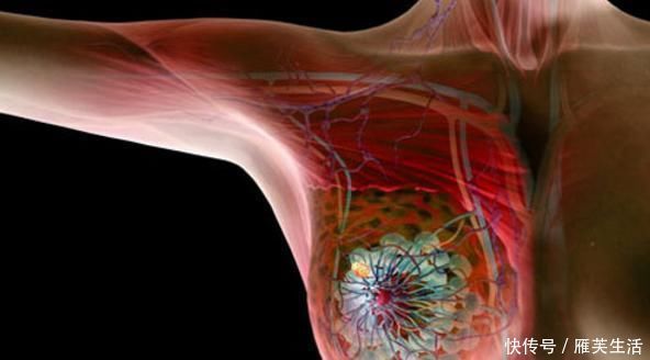 手术治疗|26岁女孩胸部疼痛,医院查出8颗肿瘤,医生:生活心态很重要