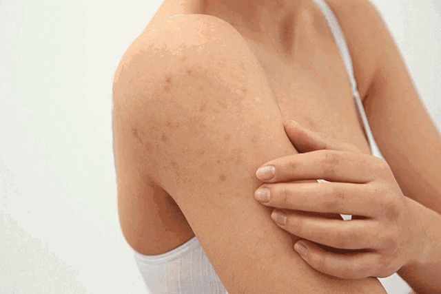 露肤的季节,如何拯救自己的“鸡皮肤”