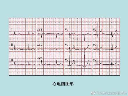心电图|如何读懂心电图？