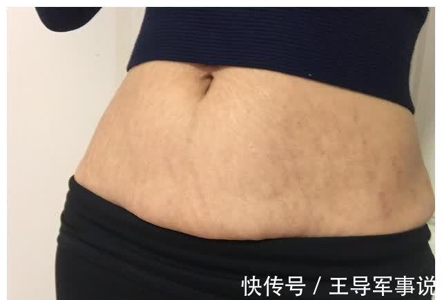 不良习惯|怀孕时想要肚子“白净”,不长妊娠纹也不留色素,需改掉三个习惯