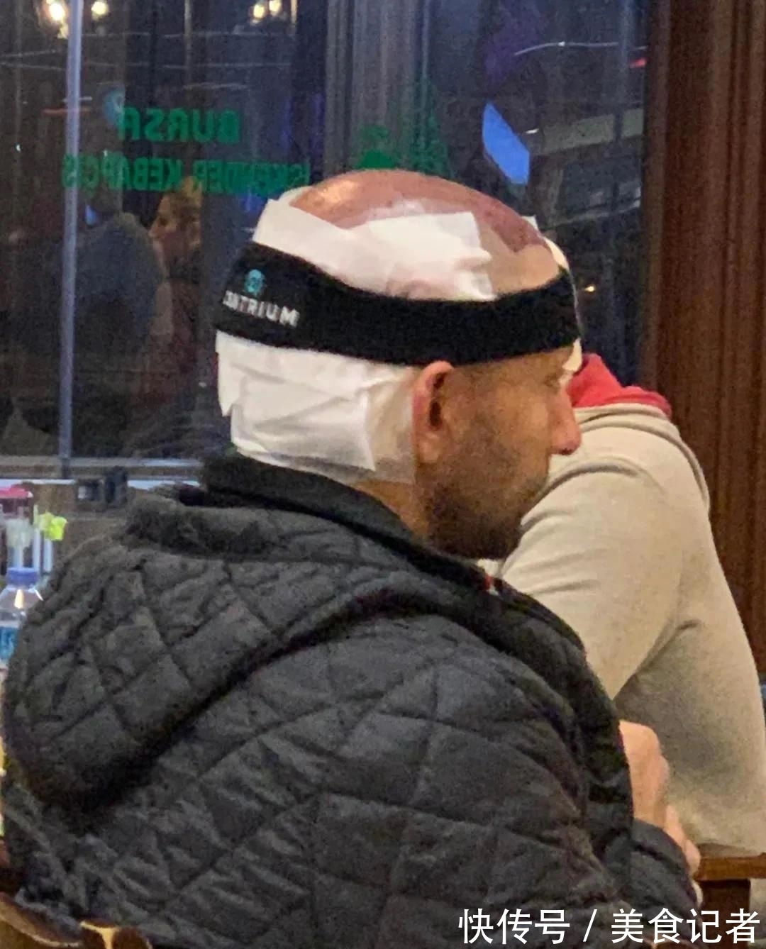 chris 每个月到底有多少人去土耳其植发?