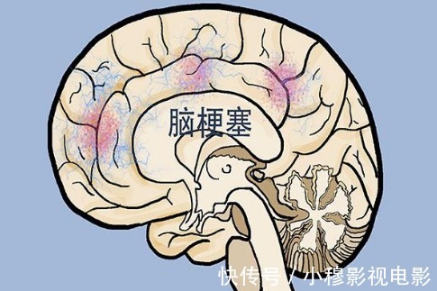 并发症|血脂高的人，多观察手指，若没这几个异常，说明脑梗离你还很远