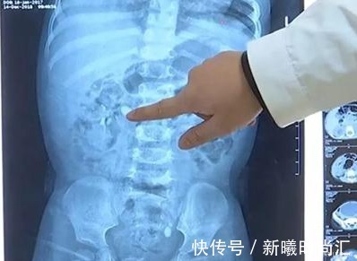 结石|15个月宝宝被查出“结石”,因父母冲奶粉行为错误,伤害了娃
