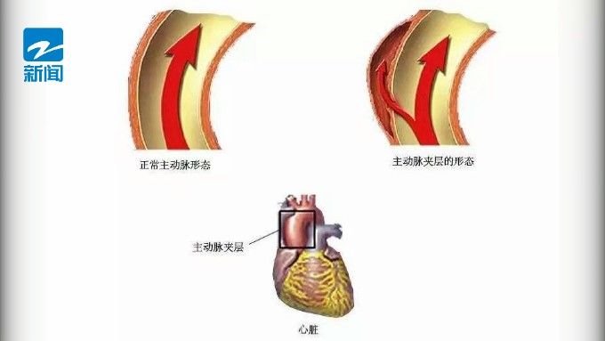 崔勇|浙江一男子“痛到像被劈成两半！”医生：可能瞬间死亡，这些人要当心