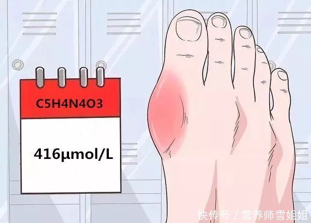 一旦查出尿酸高，少碰二物，改掉三习，做好四事，稳降尿酸少痛风