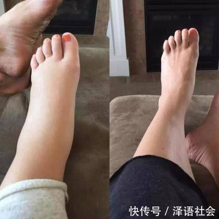 积液|为何怀孕后脚会变大?生完娃后还能恢复如初吗?