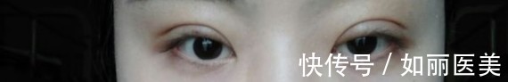 手术 什么样的双眼皮手术意味着失败了?术后多久才能进行二次修复?看完这篇,你就知道啦~