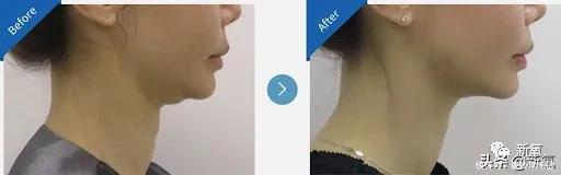 半个娱乐圈女明星脸上都有的这个坑,真的是线雕的锅吗?