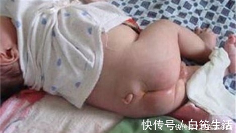 小尾巴|新生宝宝竟然长了条小尾巴, 原来是妈妈怀孕时少吃了这个!