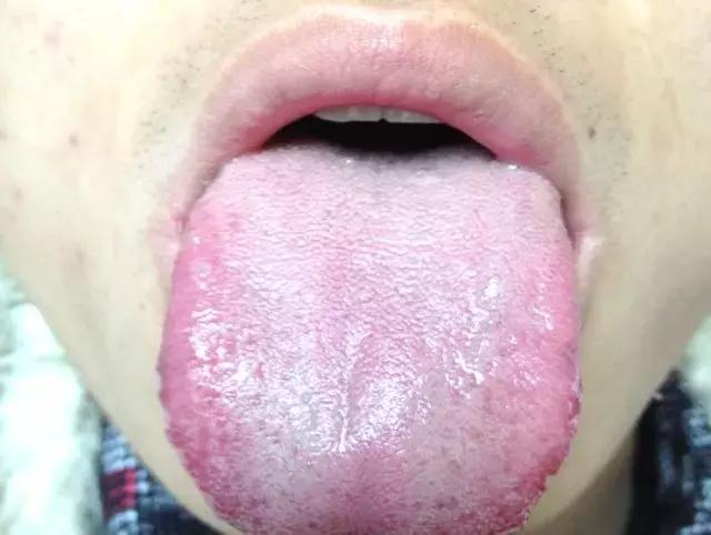 舌诊|中医医生总看舌头都在看什么九种体质+珍贵的舌诊图谱