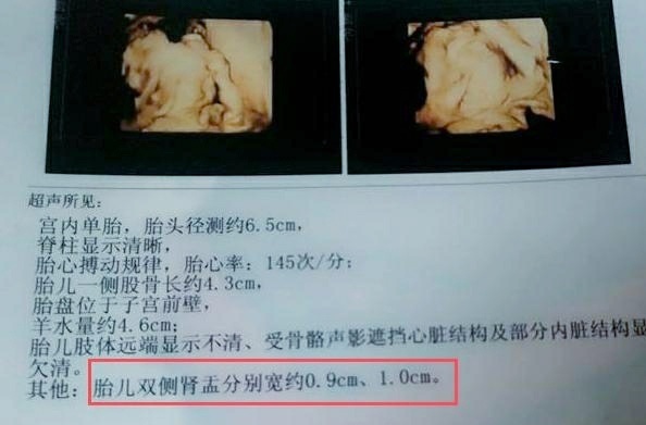 孕妇|胎儿双肾盂分离,孕妇很高兴,“这下儿女双全了”,医生苦笑摇头