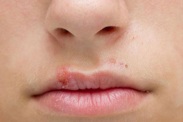 口腔溃疡|嘴上经常长泡，是怎么回事可能是这4种疾病的“信号”，别忽视