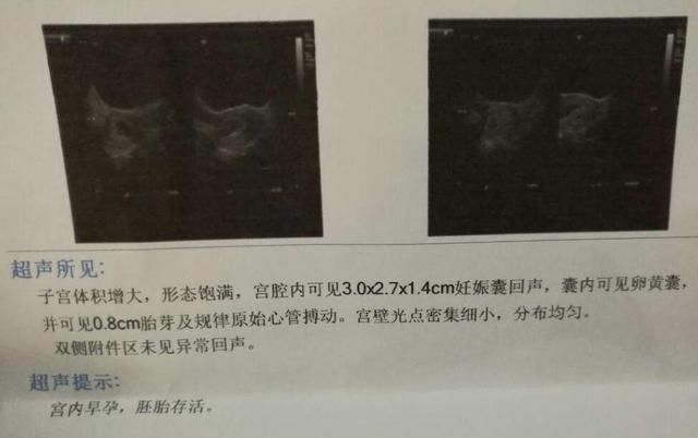 真的|“空孕囊”真的只有胎停育一种结果吗？也许还有另一种结果……