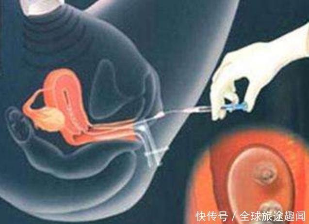 试管婴儿|女性做试管婴儿到底有多疼?镜头记录全过程,母亲真伟大!