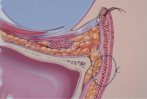 都是去除多余的脂肪，为什么大腿吸脂不容易反弹，而去眼袋会反弹？