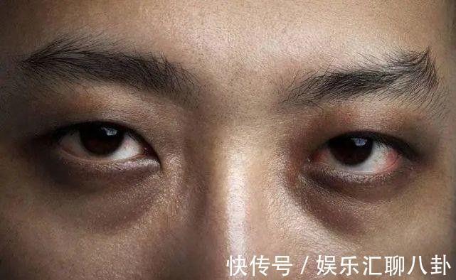 乳酸|早期肝硬化,身体会浮现出“9大症状”,占一半以上,要及时就医