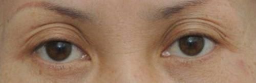 你的眼皮都有几层了?