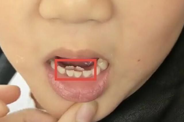 甜食|7岁男孩长了“双排牙”,需要一颗一颗拔掉,奶奶自责不已
