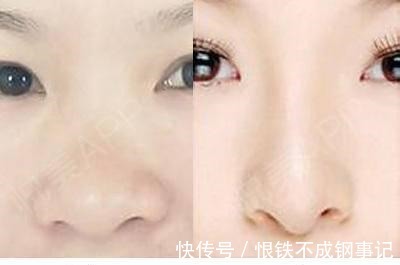 手术 王志坚医生可以单独只做鼻翼缩小手术吗!