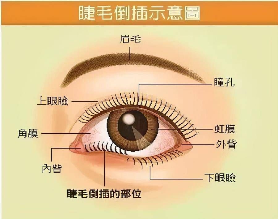 结膜炎|杭州眼整形徐刚主任：经常揉眼睛不一定是困，有可能是倒睫