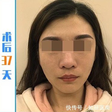 周女士 45岁女士拉皮手术便签记录“曝光”，脸好像小了一圈