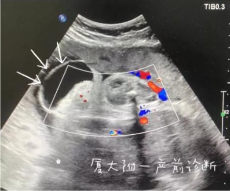 尾巴|崩溃！厦门一女子怀孕5个月，发现胎儿竟有“尾巴”，医生说……