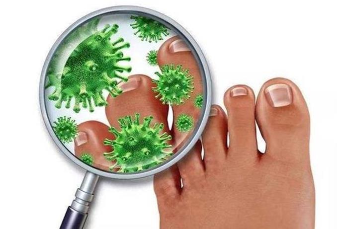 真菌|“脚气”真菌怎么做才能根除?2个简单小方法,彻底治好不复发!