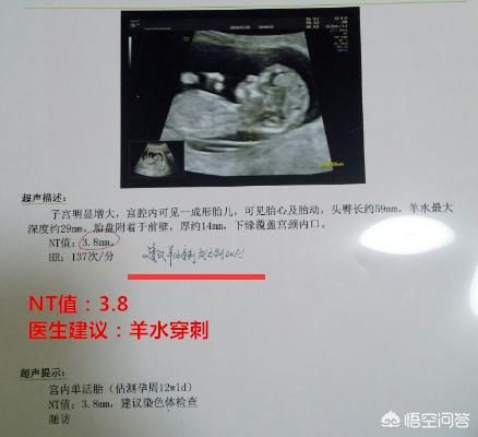 胎儿NT检查3、6意味着什么？