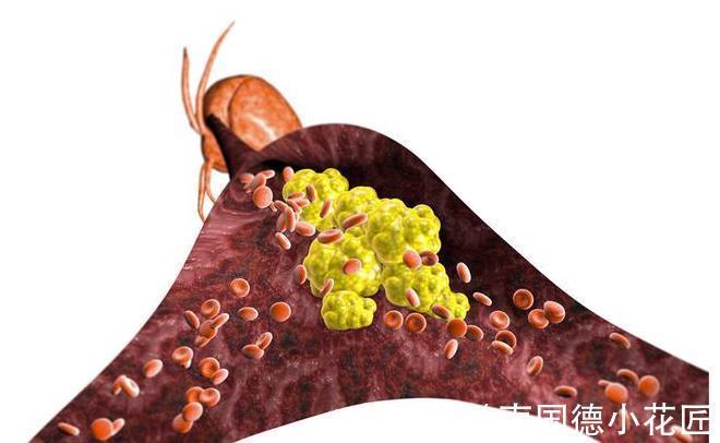 身体|血脂过高，身体可能会“惹”上哪些疾病？