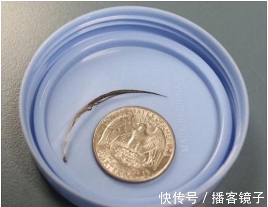 女婴|父母带着脖子突出一根东西的女婴去医院 一往外拉连医生都吓傻