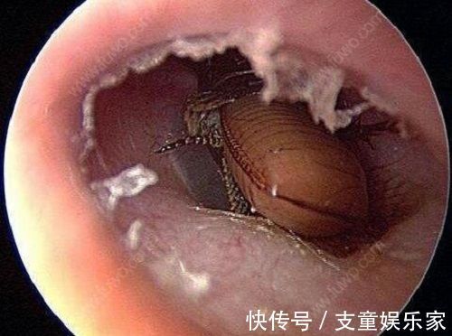 奶奶|6岁女孩耳朵半夜进虫子,奶奶接下来的操作,医生都连连称赞!