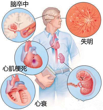 “普利”和“沙坦”，降压好“兄弟”，先看哥哥“普利”