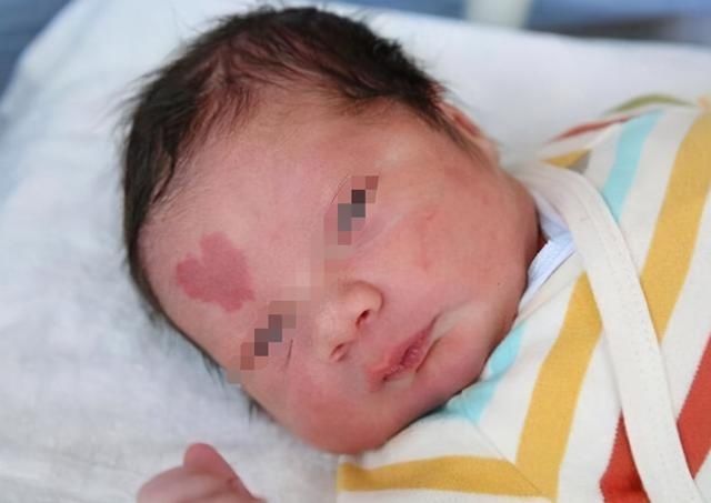 垃圾食品|胎记是如何形成的？产科大夫：除了遗传，和孕妈3种不良行为有关