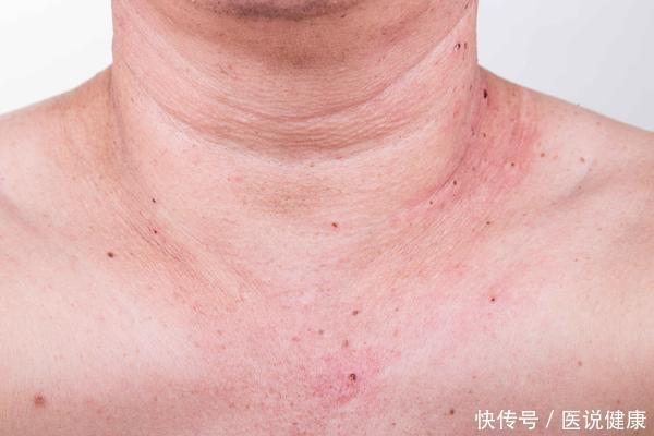 皮肤|皮肤出现这3种“怪象”,不能拖,或是糖尿病的“敲门声”!