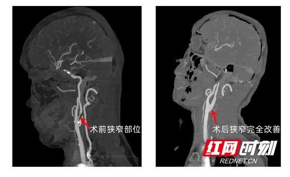 Xiangxi People's Hospital successfully carried out carotid endarterectomy for the first time