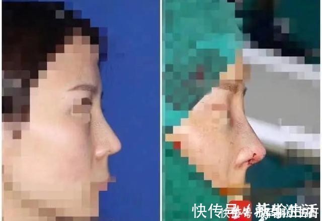 鼻尖 女子整容后山根晃动、鼻尖发白!手术方:很成功,已起诉