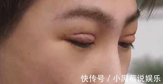 小伙|小伙为了变得更加帅气去割双眼皮,割完之后他的人生都发生了变化