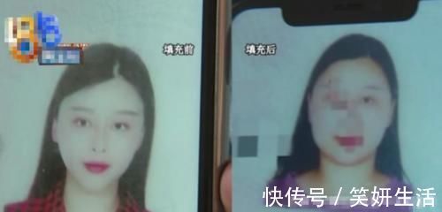 女子|女子做脂肪填充,结果整成大饼脸要求退款,院长不露面选择报警