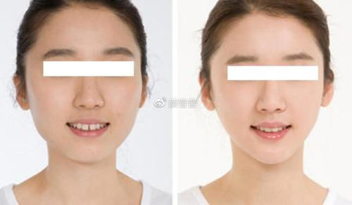 假体|颏成型术和假体垫下巴有啥区别?下巴短还后缩做哪个好?