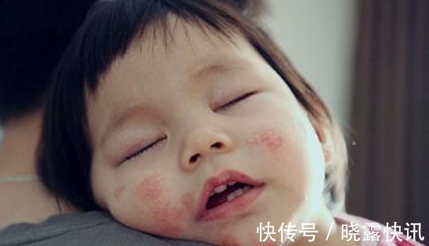 过敏性|儿科医生建议最好别给宝宝吃鸡蛋羹,还在喂的家长,需要注意